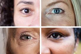How to fix uneven eyes without surgery?, can lack of sleep makes the eyes uneven ?, how do i get rid of uneven eyes? The Fix For Dark Circles Bags And Droopy Lids The New York Times