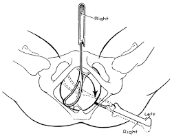 Image result for Forceps Assisted Delivery