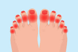 Learn and reinforce your understanding of sole: Arthritis In Toes Symptoms Causes Diagnosis And Treatment