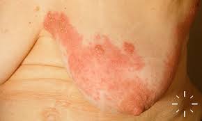 Image result for zoster under breasts
