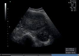 Currently there are ten obsp sites located in waterloo wellington region: Sonographic Assessment Of Uterine Fibroids And Adenomyosis Chapter 4 Gynaecological Ultrasound Scanning