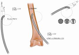 A wide variety of humerus nail options. Flexible Intramedullary Nailing Fin In Diaphyseal Fractures In Children Springerlink