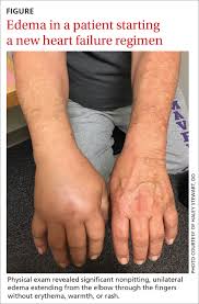 Image result for Edema Exam