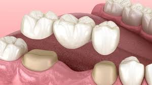 Anda memiliki gigi molar yang berbeda saat anda tumbuh dewasa. Dental Bridge Gigi Palsu Permanen Yang Aman Digunakan