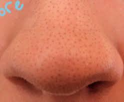 I pinch between finger and thumb the ragged black corsage momentarily overcome left eye, a tear, discharged. Get Rid Of Those Horrid Blackheads On Your Nose Musely