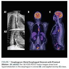 What Are The Most Common Esophageal Metastases Cancer Network