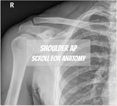 This flexibility allows us to reach objects overhead as well as behind our backs. Shoulder X Ray Labelled Anatomy Radiology Case Radiopaedia Org