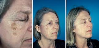After surgery to remove skin cancer, you may have many concerns, one of which is probably how you will look.this is especially true if the surgery was performed on a prominent and important area like your face. Facial Skin Cancer