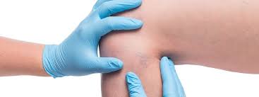 Ich nenne dir die ursachen einer thrombose, zähle die ursachen auf, wie thrombose entstehen kann und das. Thrombose Die Unterschatzte Gefahr Fur Frauen Mdr De