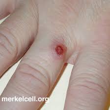 Image result for Merkel Cell Carcinoma