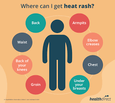 Image result for sweat rash on back