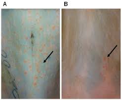 Image result for Varicella zoster on human skin