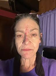 Here's my deal.. I have some fatigue, intermittent joint discomfort rarely  pain, dry eyes and some neuropathy, nothing too much to just live with. So…  my Sarc Dr didn't treat me since