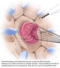 Image result for Rectal prolapse