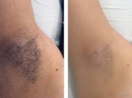 ‫کرم برای سیاهی کشاله ران و زیربغل‬‎