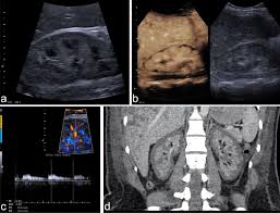 Vein mapping uses a painless sound wave (ultrasound) to look at your veins. Multiparametric Ultrasound Findings In Acute Kidney Failure Due To Rare Renal Cortical Necrosis Scientific Reports