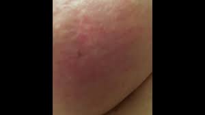 Image result for Inflammatory breast cancer