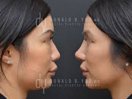 Beverly Hills Facial Plastic Surgery