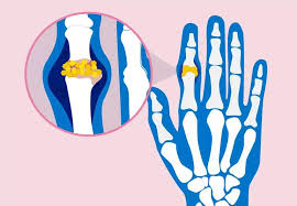 Image result for gout