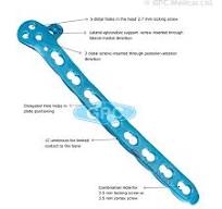 2.7/3.5mm Distal Humerus Locking Plate with Lateral Support ...