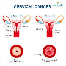 It is due to the abnormal growth of cells that have the ability to invade or spread to other parts of the body. Cervical Cancer Causes Symptoms And Treatment Netmeds