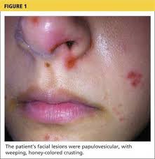Small bumps on face rash. Woman 32 With Crusty Red Blisters Clinician Reviews