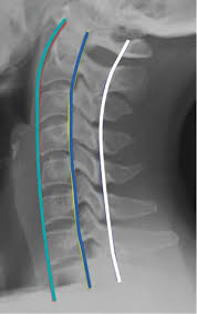 Anterior vertebral line spinolaminar line : Cervical Spine The Bmj