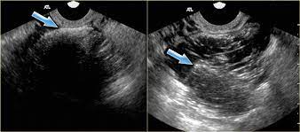 We did not find results for: The Radiology Assistant Roadmap To Evaluate Ovarian Cysts