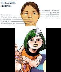 Where one fold is more pronounced, it can simulate esotropia. Adventurealleyproductions Flat Nasal Bridge And Epicanthal Folds Fetal Alcohol Syndrome Small Palpebral Fissures Railroad Track Ears Low Nasal Bridge Epicanthal Folds Jpturned Midface Nose Smooth Philtrum Thin Vermilion Border Underdeveloped Jaw