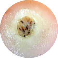 Image result for verrucae filiformes