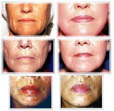 Glycolic Peels Before And After Chemical Peel Peeling Skin Acne Scar Removal