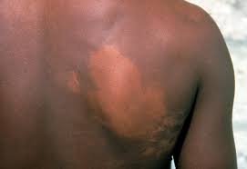 In some cases, granulomas are indistinct and the findings are limited to lymphocytes along superficial vascular plexuses (as shown here). Leprosy Borderline Tuberculoid Leprosy Wellcome Collection