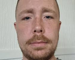 Man catches rare 'flesh-eating' infection after being 'stabbed' in head  with a key