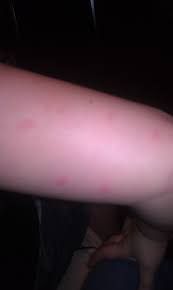 But then again if you have little kids around, be cautious doing that. Pictures Of Bed Bug Bites On Kids Bed Bug Bites Bed Bugs Bugs