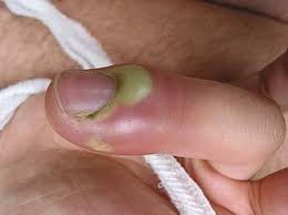 Image result for phlegmon of hand)