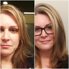 Ok, so I told you all that I had a lot of hair loss after a series of  surgeries. But I wanted to drive the point home about how much hair I