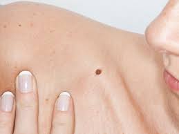 Of course, your specialist is the main person whose advice you should follow but it doesn't do anyone harm. Moles May Be Sign Of Higher Breast Cancer Risk Cbs News
