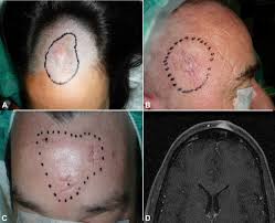 Image result for Dermatofibrosarcoma Protuberans