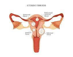 Check spelling or type a new query. Should I Be Concerned About My Fibroid Tumor