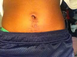 Back of neck $100 front of neck $100 lower legs $125 upper legs $125 buttocks $125 lower back $125 line below belly button $100. How Do I Get Rid Of These Hideous Spots Photo