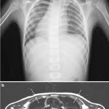 Pediatric radiology volume 40, page51(2010)cite this article. Conventional Radiography Of Posteroanterior Chest Shows The Cardiac Download Scientific Diagram
