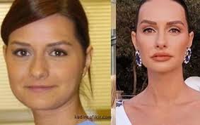 Doktorlar Ela Estetikli Unlulerden Olup Botox Rhino Ve Lip Islemlerine Tabi Olmus Kadinca Fikir Kadinca Fikir Unluler Kadin Fotograf
