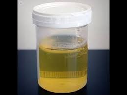 Image result for Isolated Proteinuria