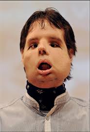 A 31-year-old Spanish man who was injured in a shooting accident appeared in public today to show off the world&#39;s first full-face transplant. - transplantx-large