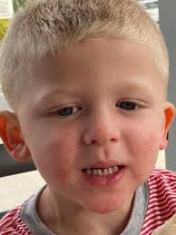 What do you use for an unplanned sunburn?