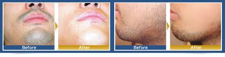 removing unwanted hair such as beard