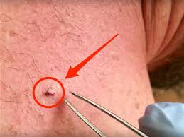In general, ingrown hairs look like small red bumps on the skin that center on a hair follicle. Video Pulling Out A 6 Year Old Ingrown Hair