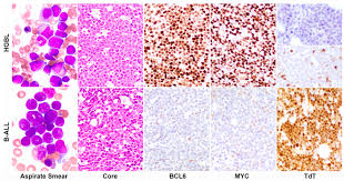 Unique pathologic features and gene expression signatures distinguish  blastoid high-grade B-cell lymphoma from B-acute lymphoblastic  leukemialymphoma | Haematologica