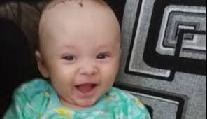 In general, brain tumors in children are very rare. Bosnian Baby Receives Brain Tumor Treatment In Turkey The Peninsula Qatar