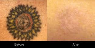 In general, it takes about six to eight sessions to completely remove a tattoo, so you're looking at a minimum of $1,200 to have your tattoos entirely erased from your body. Pin On Tattoo